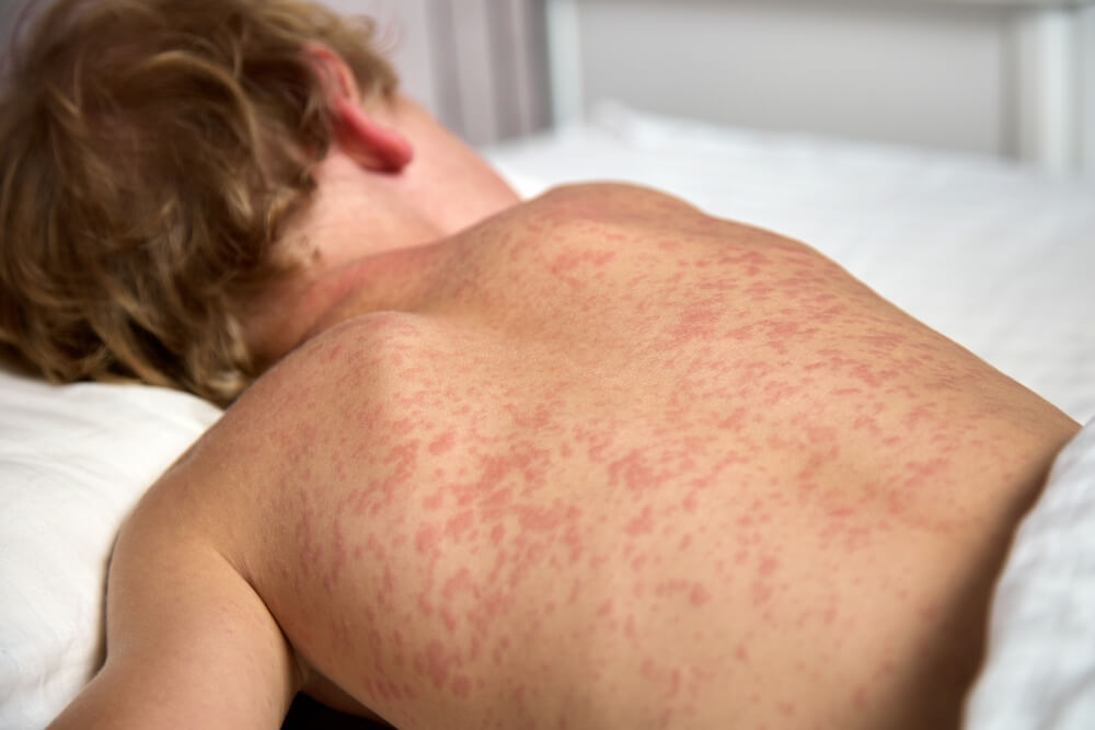 Europe Faces Renewed Measles Risks as Vaccination Coverage Stalls